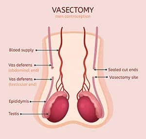 vasectomy graphic